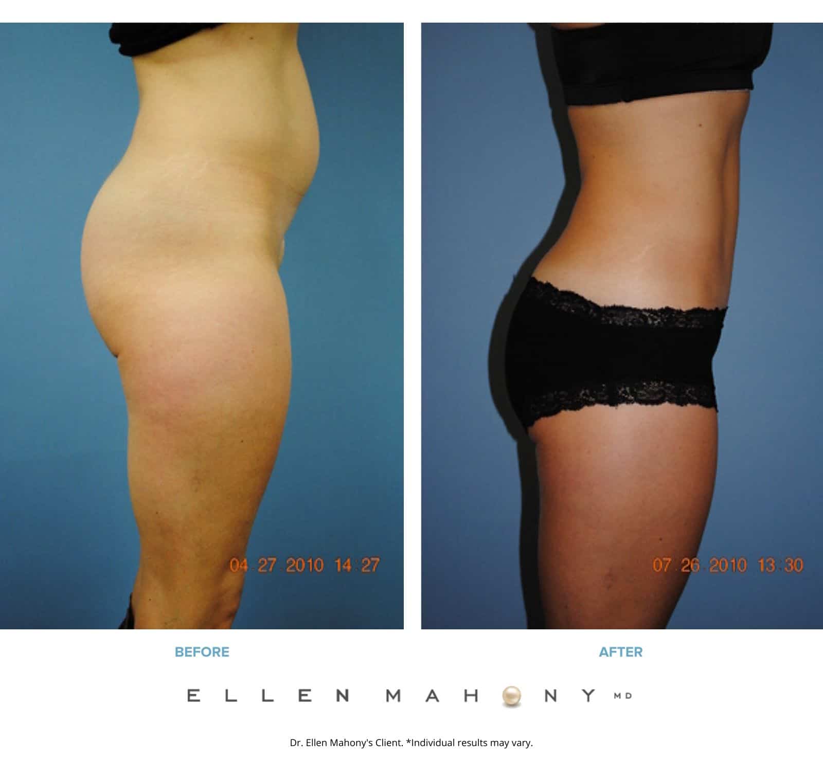 Mini Tuck And Tummy Tuck (abdominoplasty) Before & After Photos Patient 07