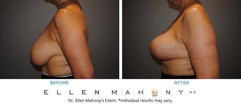 Breast Reduction Fairfield County