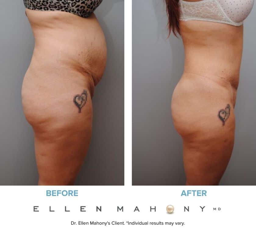 Why Is The Mons Pubis Puffy After Kids and/or Liposuction? Live Tummy Tuck  Explained! 