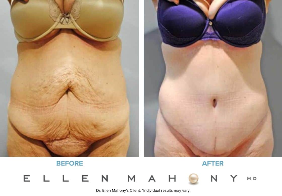 Mons Lift Turkey - Pubic fat liposuction (monsplasty) - Dr. Ali Mezdeği