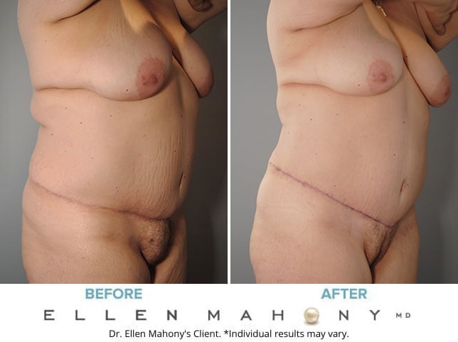 Tummy tuck with liposuction of the mons pubis, and a pubic lift