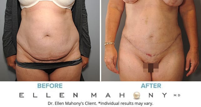 38 F Before and After Liposuction