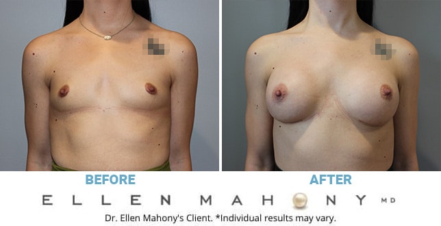 Improve the Size and Shape of Your Breasts with Breast Augmentation - Colen  MD Plastic Surgery