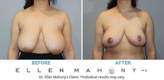 Breast Reduction Archives 