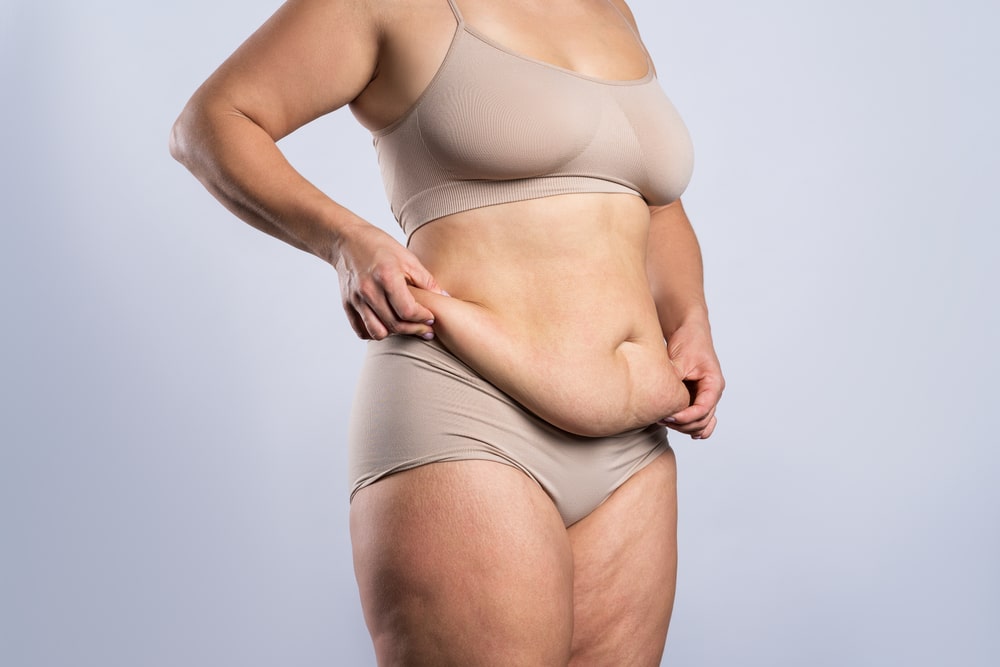 Woman's body with some loose skin after significant weight loss