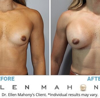 Breast augmentation 32A to 34DD - Review - RealSelf